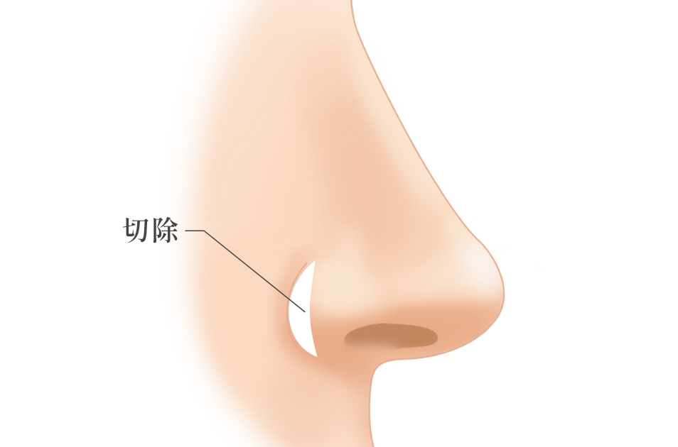 鼻翼縮小とは