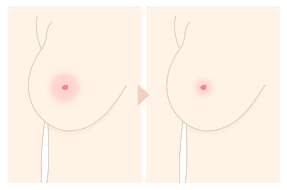  乳輪縮小とは