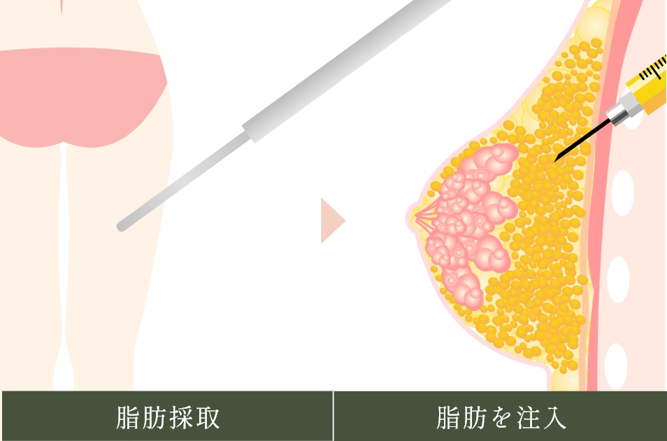  脂肪注入豊胸とは