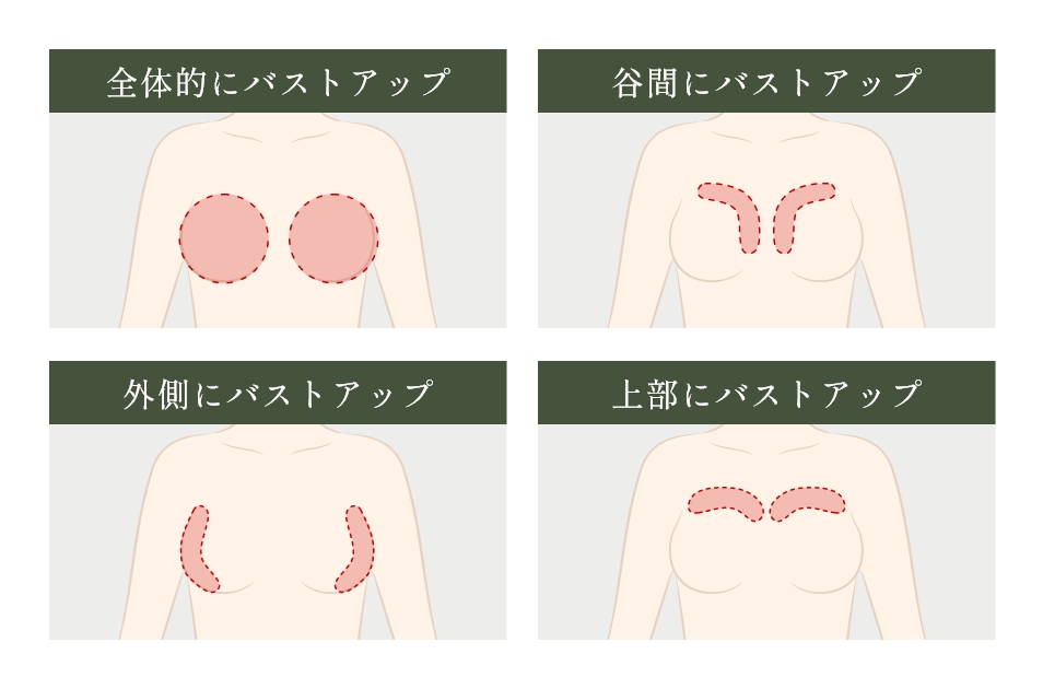  脂肪注入豊胸のデザイン
