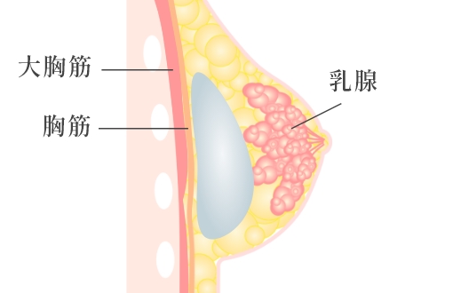  乳腺下法