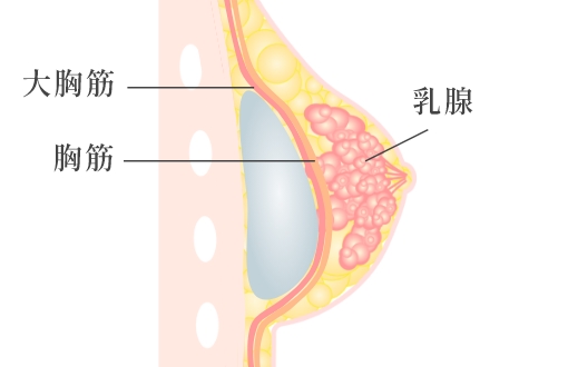  大胸筋下法