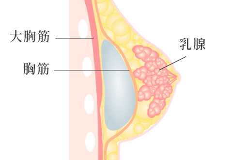  大胸筋膜下法