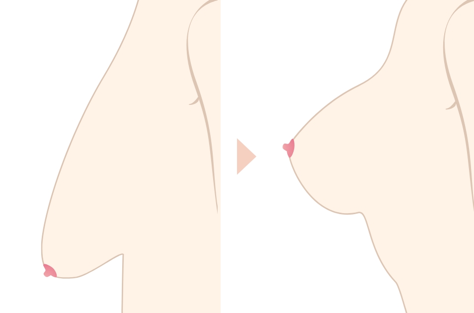 乳房吊り上げ術