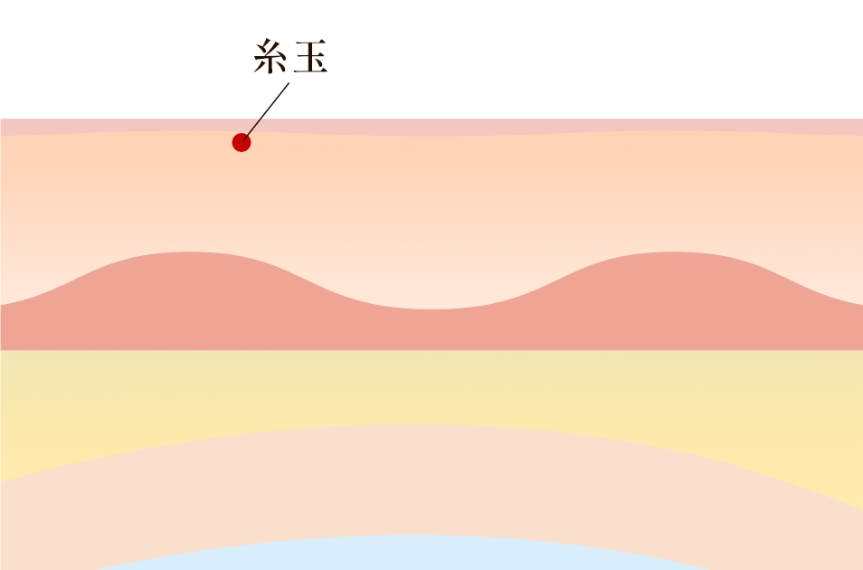 当院の二重埋没法