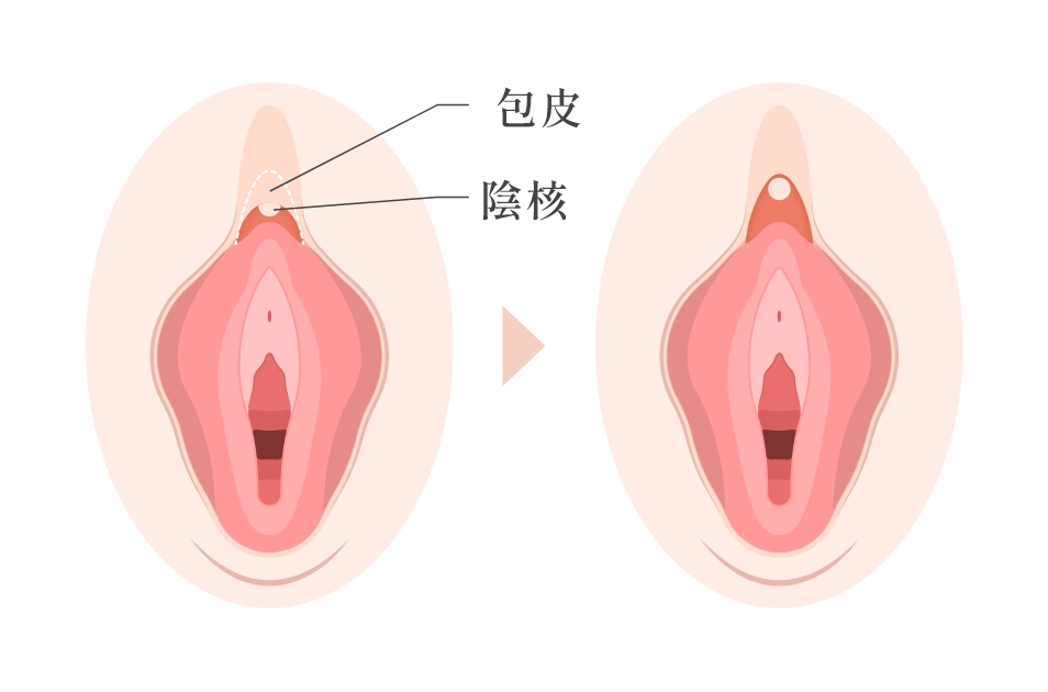 陰核包皮切除とは