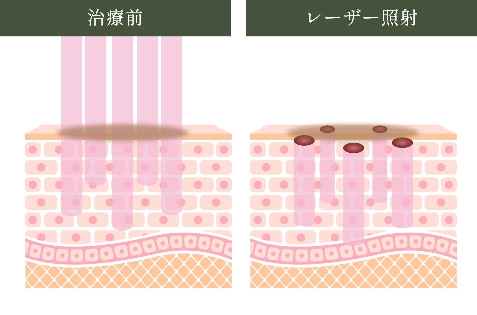 CO2フラクショナルレーザーのメカニズム