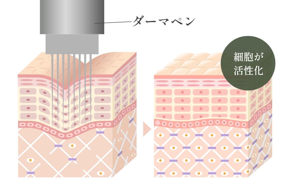 ダーマペン4の仕組み
