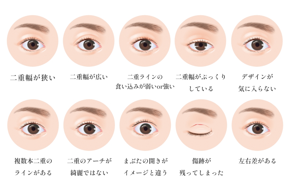 二重切開でよくある失敗