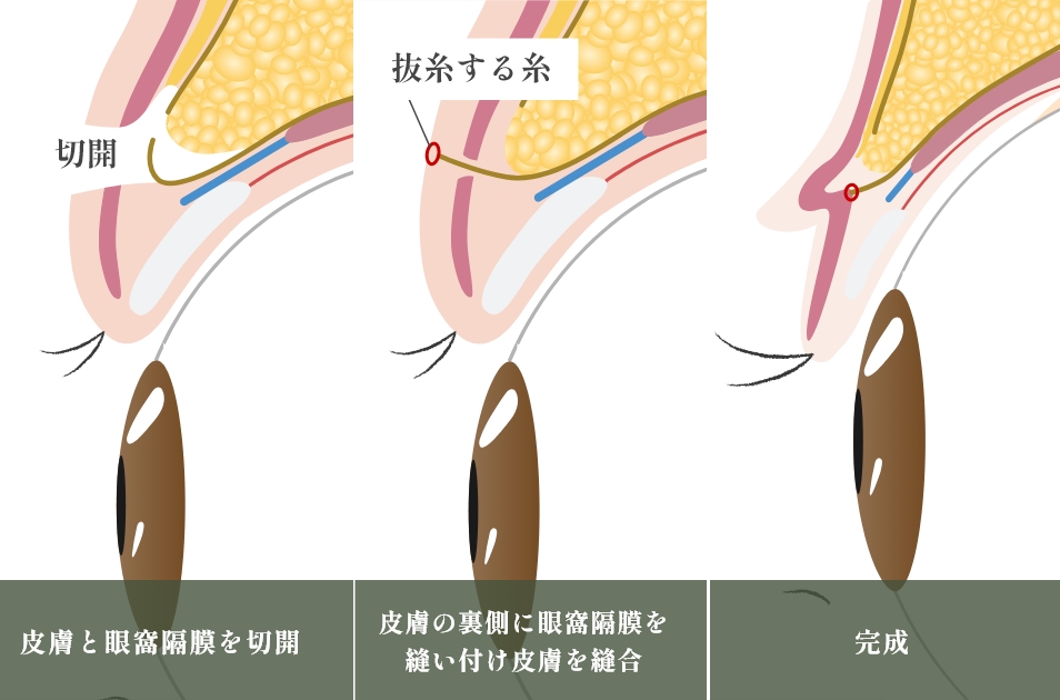 二重切開法とは