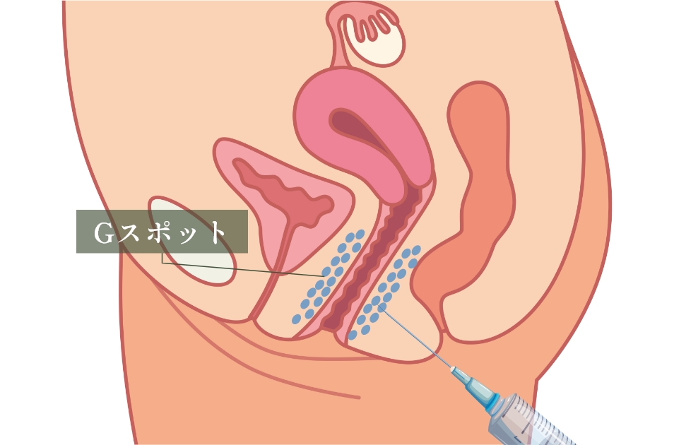 Gショットとは