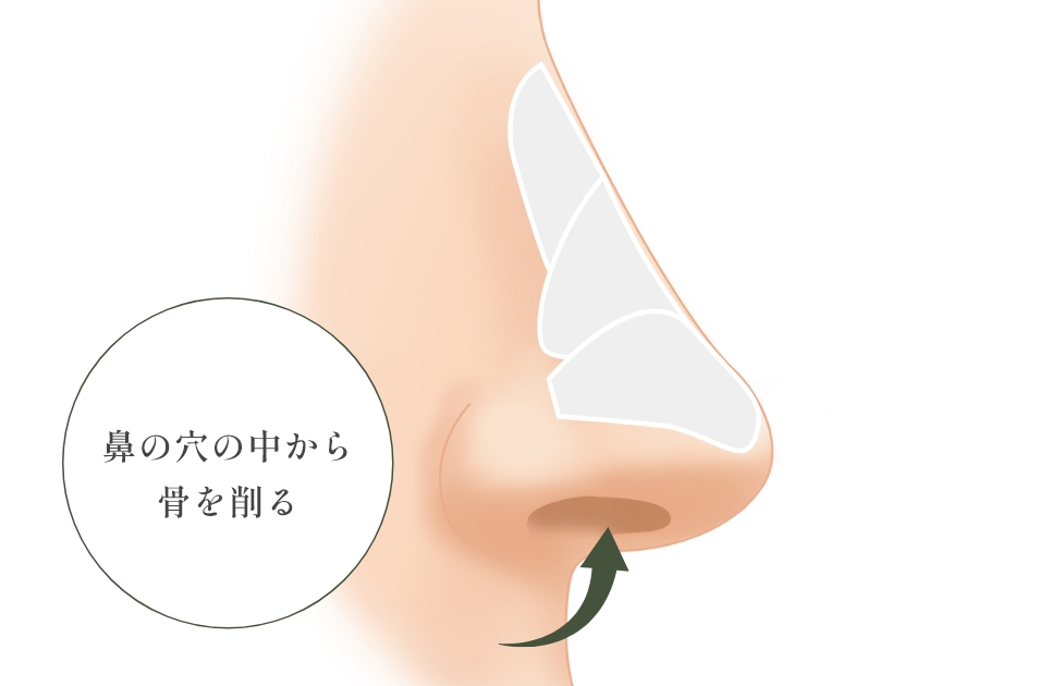 わし鼻修正とは