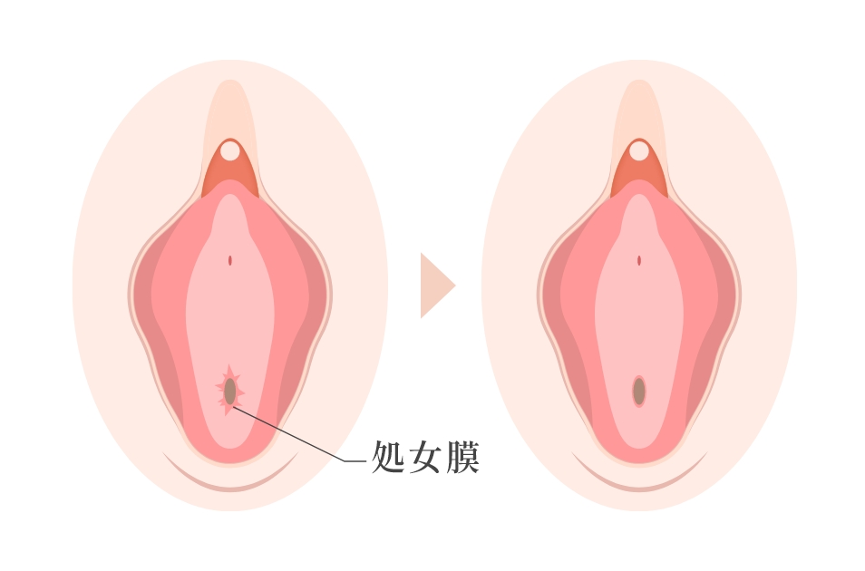 処女膜再生