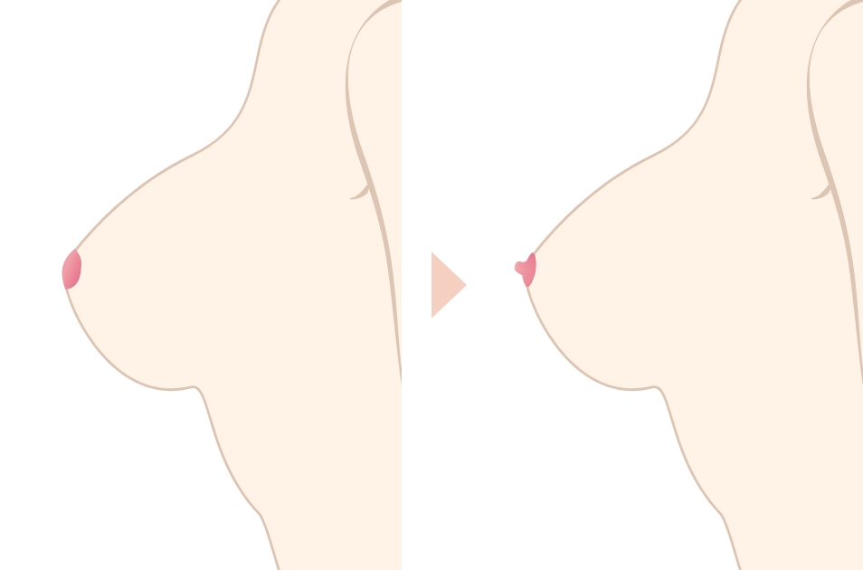  陥没乳頭形成術とは