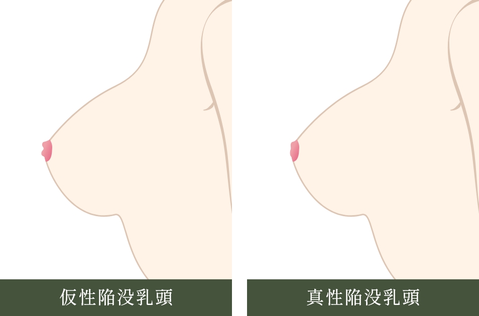  陥没乳頭（陥没乳首）の症状