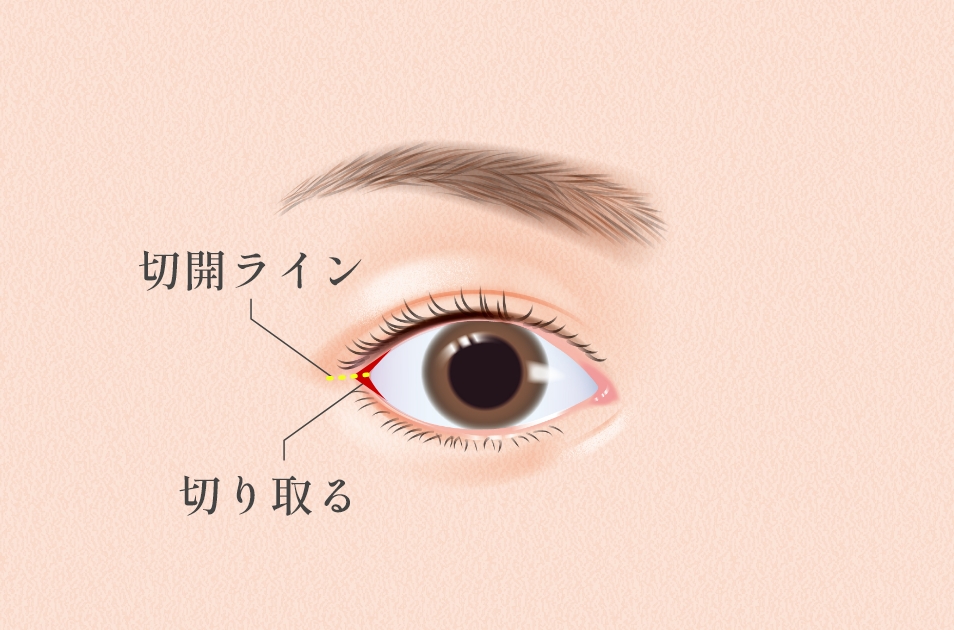 目尻切開とは