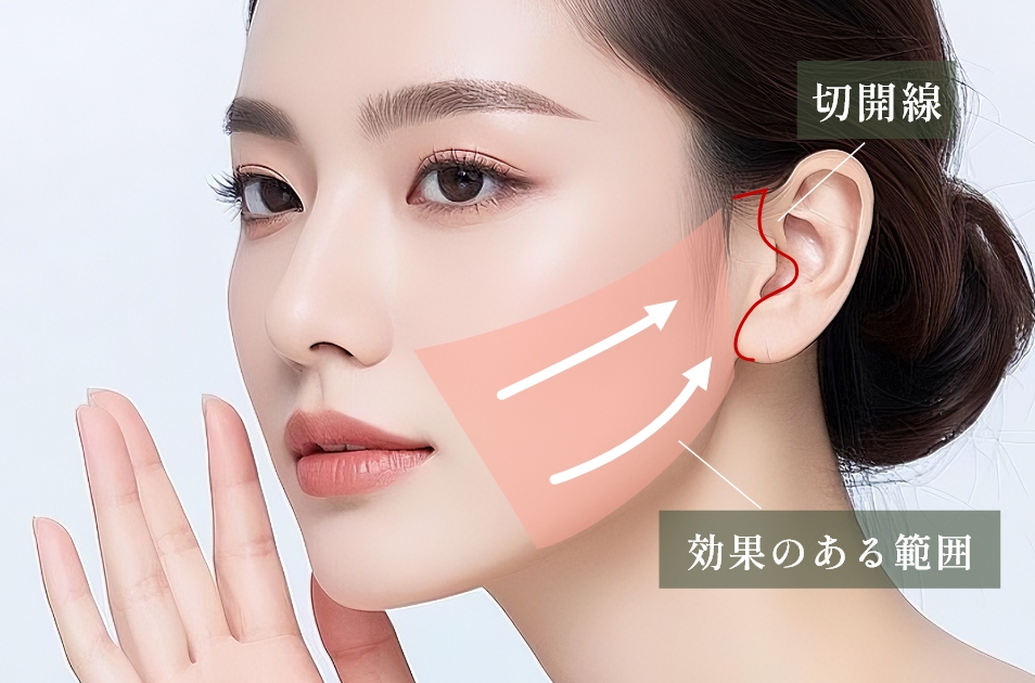 ミニフェイスリフトとは