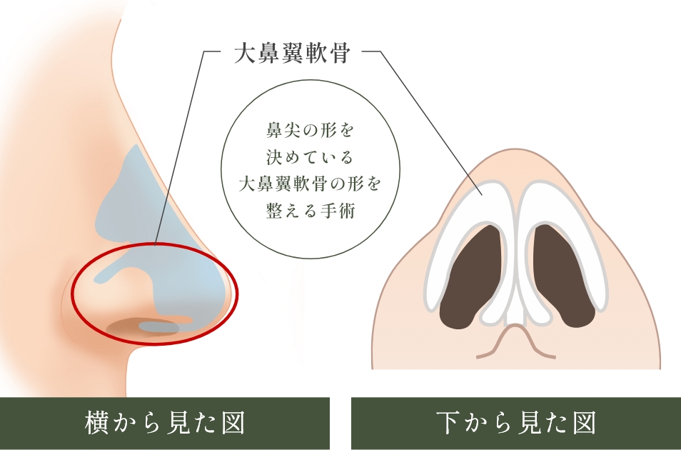 鼻尖形成とは