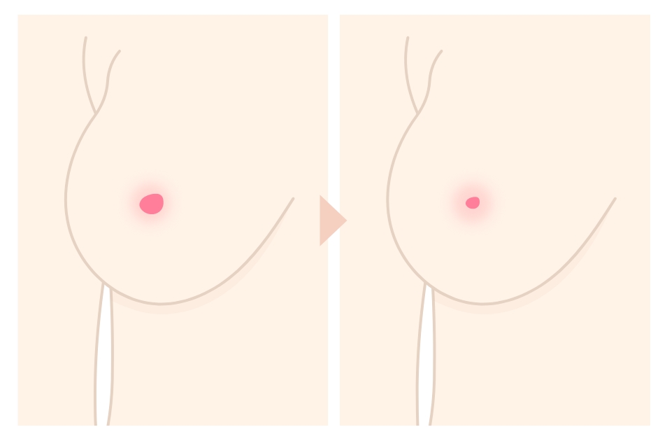  乳頭縮小とは