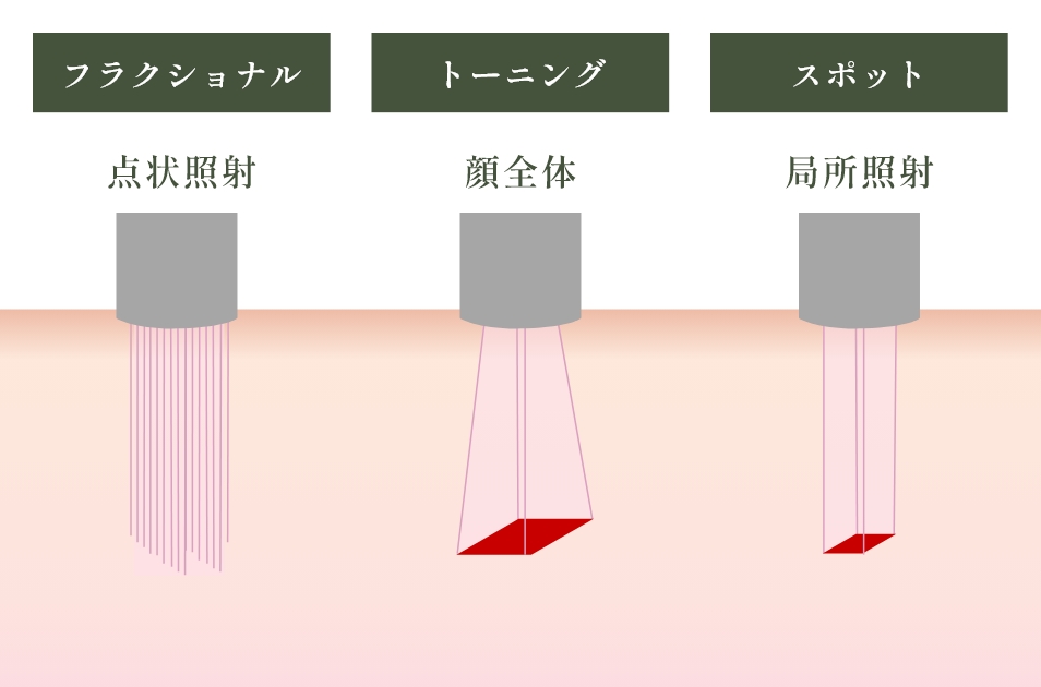 ルビーレーザーの照射モード