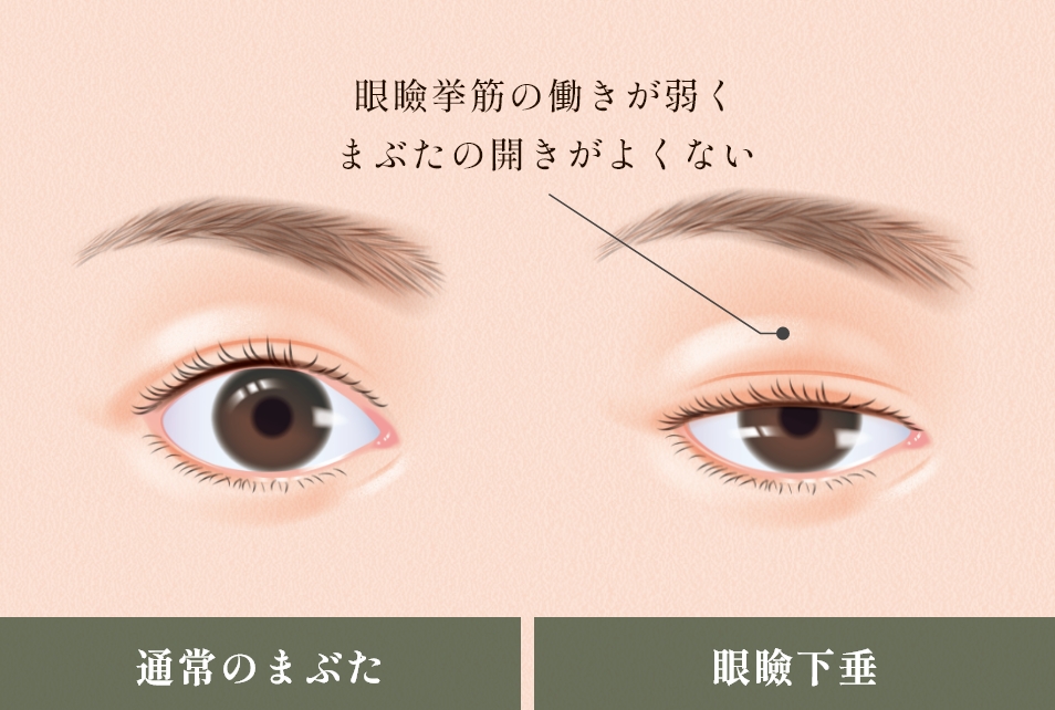 眼瞼下垂の原因
