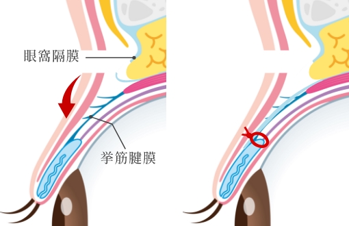 挙筋腱膜前転法