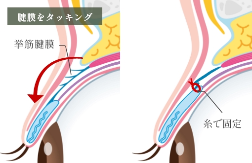 挙筋腱膜タッキング法