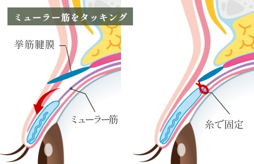 ミュラー筋タッキング法