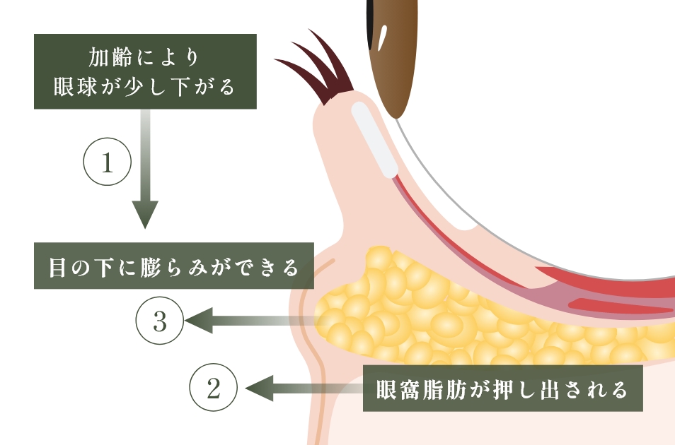 クマ・たるみができる原因