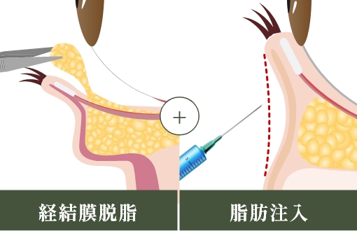 経結膜脱脂と併用する
