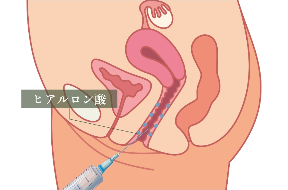 膣ヒアルロン酸注入とは