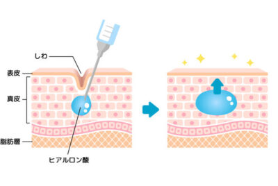 ヒアルロン酸注入で何ができるの？初めてのヒアルロン酸ガイド