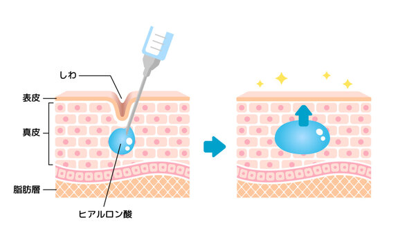 ヒアルロン酸注入で何ができるの？初めてのヒアルロン酸ガイド｜名古屋