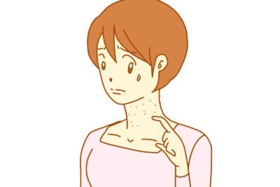 いぼの治療について