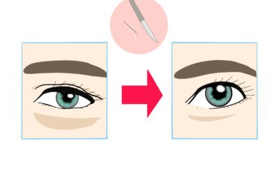 形成外科で治す眼瞼下垂｜名古屋の保険適用料金公開