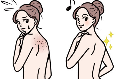 皮膚科医が教える背中ニキビの受診目安と治療法