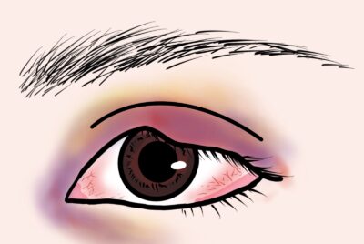 埋没法〜内出血が出た時の対処法〜