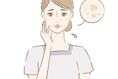 シミ取りで失敗！どうしたら成功したの？