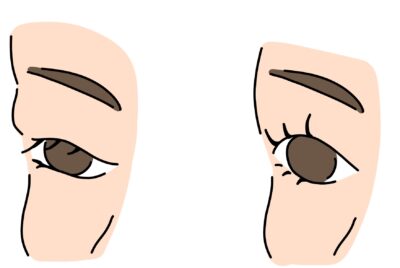 まぶたの脂肪取りだけで本当に変わる？効果と注意点