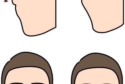 人中短縮の失敗回避と傷跡修正の全知識〜後悔しないために〜【完全保存版】