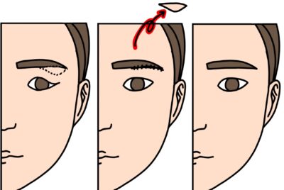 【眉下切開完全ガイド】傷跡は大丈夫？ボコボコにならない？どうしたら傷が綺麗になる？