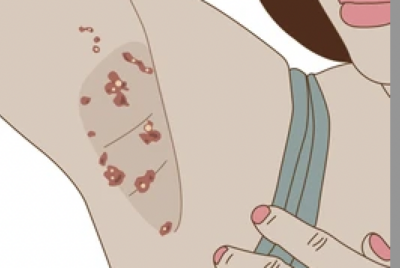 写真でわかる化膿性汗腺炎の症状と危険サイン〜原因は？自分で治せる？市販薬は効くの？〜