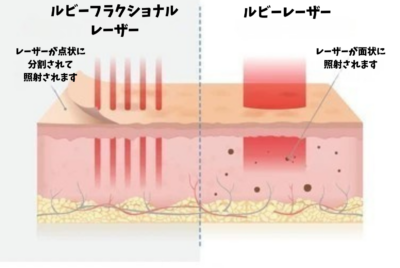ルビーフラクショナルレーザー徹底ガイド〜ダウンタイムは？効果は？治療間隔は？肝斑には効く？〜