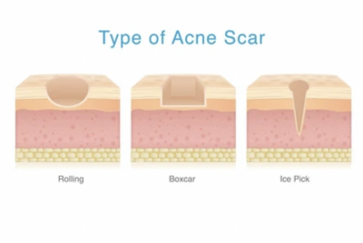 【形成外科専門医監修】TCAクロスで治すアイスピック型ニキビ跡徹底ガイド