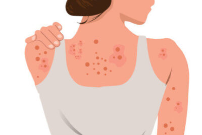 慢性膿皮症とは｜原因・症状・治療法を図解で完全解説