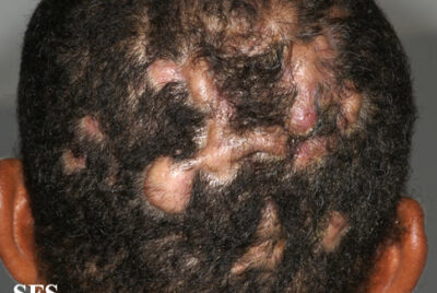 膿瘍性穿掘性頭部毛包周囲炎とは?治療法は?