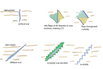 W形成とZ形成の違いを専門医がやさしく解説