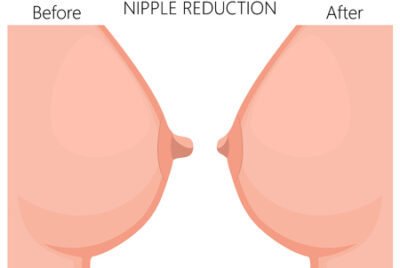 乳頭縮小の術式の選び方〜授乳機能を残したい場合やしっかり小さくしたい場合の術式の選択を形成外科専門医が解説〜