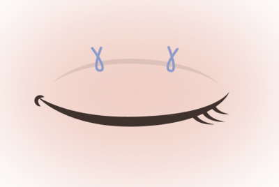 二重埋没法で失敗しないためには