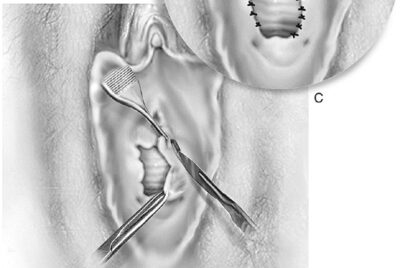 処女膜切開、処女膜強靭症について〜性交痛に悩まれる方へ〜